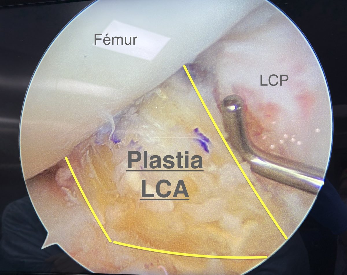 Plastia de ligamento cruzado anterior