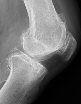 Radiografía de artrosis de rodilla (proyección de perfil)