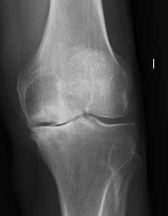 Radiografía de artrosis de rodilla (proyección frontal)