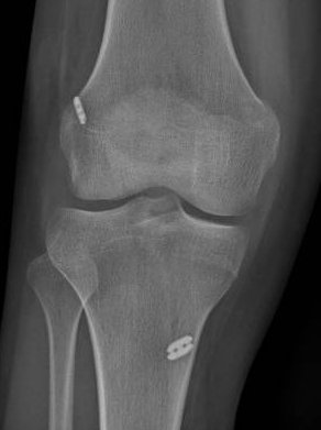 Radiografía de plastia de ligamento cruzado anterior