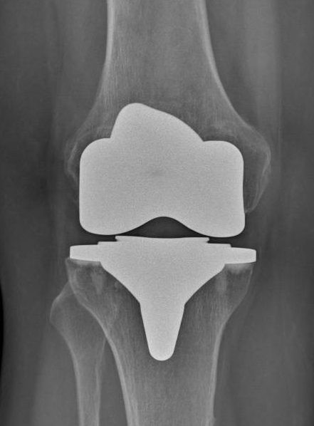 Radiografía de prótesis total de rodilla