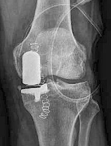 Radiografía de prótesis parcial de rodilla