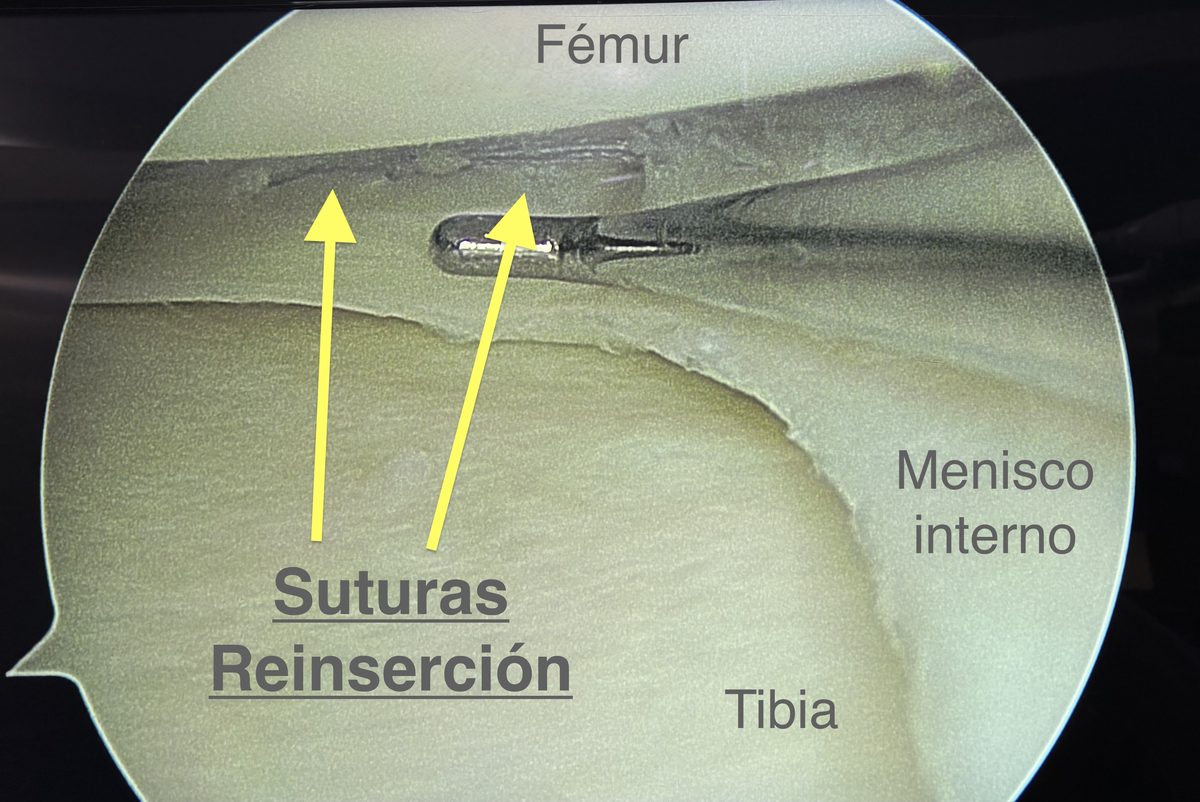 Sutura y reinserción meniscal